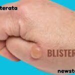Blisterata